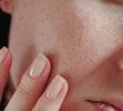 آیا منافذ باز روی پوست صورت خود دارید؟ با راه های خلاص شدن از شر آنها آشنا شوید